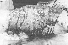 Fig. 2b - Wound surface covered with amniolic membrane after excision.