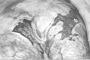 Fig. 2b - Lesions in buttock surface after swab debridement.