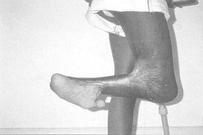 Fig. 1 - Severe post-burn contracture of knee and ankle.