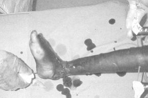 Fig. 3 - Kirschner wire used to stabilize joint after tibiotarsal capsulotomy.