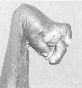 Fig. 7 - Extreme contracture of right hand in girl aged 16 yr following hum suffered in childhood.