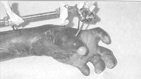 Fig. 9 - De Bastiani device applied to maintain and increase extension by daily adjustment of screw. Raw area on wrist covered with full-thickness skin graft from groins.