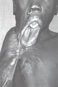 Fig. 11 - Displacement of lower lip down to thorax and of mandible showing malocclusion of about 2 cm. Right shoulder also contracted medially and abduction prevented by sear.