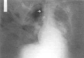 Fig. 1 - Guidewire pointed by arrows in the RX thorax