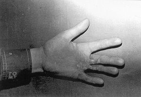 Fig. la - Hand burn deformity due to contact burn with flexion contraclure on palmar surface of 3rd, 4th and 5th metocarpophalangeal joints (14-year-old boy).