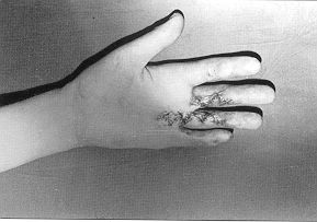Fig. 1b - After release of contracture by multiple Z-plasties.