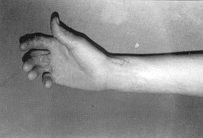 Fig. 2a - Hand bum defon-nity due to scalding with flexion contracture on palmar surface of 2nd, 3rd, 4th and 5th fingers (12-year-old girl).