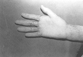 Fig. 2b - After reconstruction by contracture release with Z-plasties and full-thickness skin grafts.