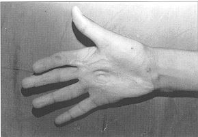 Fig. 3a - Hand burn deformity due to contact burn with flexion contracture on palmar surface of 2nd, 3rd, 4th distal metacarpal area (13-yearold boy).