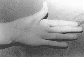 Fig. 4a - Hand bum deformity due to scalding with palmar contracture altering thumb motion (21 -year-old woman).