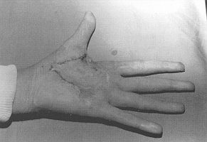 Fig. 4b - After reconstruction by contracture release and surfacing with full-thickness skin graft.