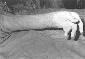 Fig. 5a - Severely deformed hand following flame burn with flexion contracture and ulnar deviation of fingers and stiff joints (54-year-old woman).