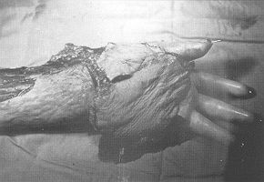 Fig. 5b - Contracture released without excision, and palmar tissue defect covered by reverse flow radial forearm flap. still present. 