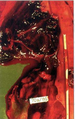 Fig. 4Plastic catheter in vena cava inferior.