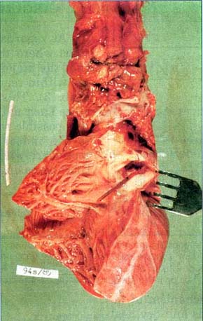 Fig. 5Plastic canula embolised into the right ventricle and pulmonary artery.