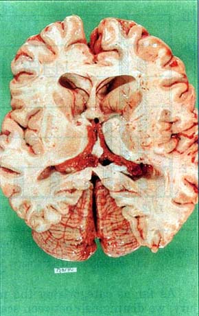 Fig. 6Inner hydrocephalus without obstruction in a boy who died due to extensive burns.