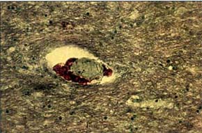 Fig. 7Red lipid deposits in granule cells - Sudan III staining.