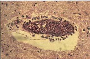 Fig. 8Perivascular gliosis - hematoxylin-eosin staining.