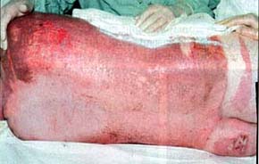 Fig. 1Superficial partial-thickness burn on day one (on admission).