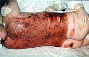 Fig. 2Deep partial-thickness burn on day three.<br>&nbsp;