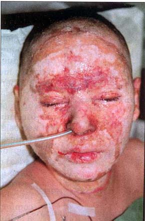 Fig. 3Deep partial-thickness burn of face in an 11-year-old boy.