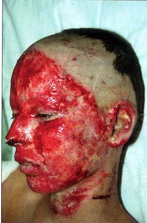 Fig. 4Tangential excision 20 days after accident.<br>&nbsp;