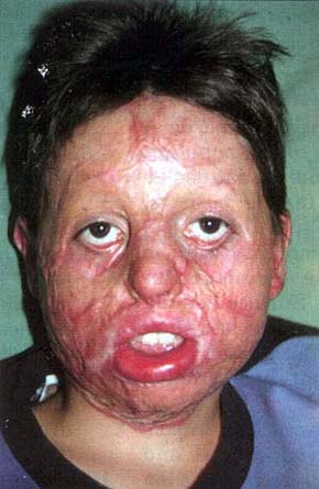 Fig. 5Healed thin split-thickness skin graft.<br>&nbsp;