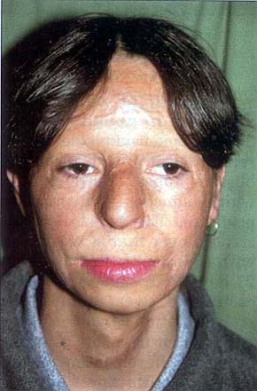 Fig. 62 years after accident: upper and lower lip + chin required reconstruction using full-thickness skin
