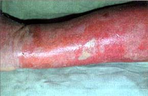 Fig. 9Deep dermal (deep partial-thickness) burn on upper extremity.;