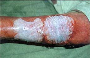 Fig. 10Burn wound after tangential excision and RHPS coverage.