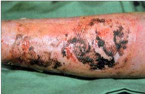 Fig. 11Healed area on day 6 after grafting.