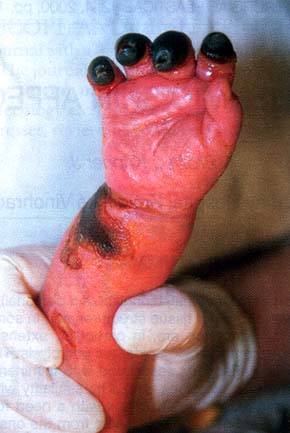 Fig. 1Necrotic changes on the forearm and gangrene of distal phalanges of the right hand.<br>&nbsp;<br>&nbsp<br>&nbsp;