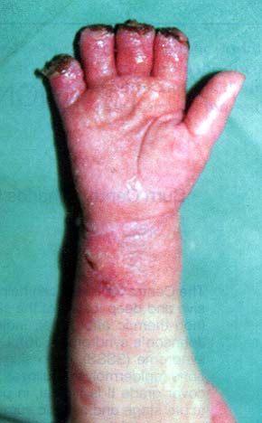Fig. 2Condition after amputation of distal phalanges of the tnd - 5tn fingers of the right hand and after autotransplantation of the defect