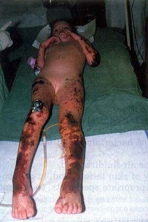 Fig. 4Deep necroses on the lower and upper ,extremities (situation on admission).