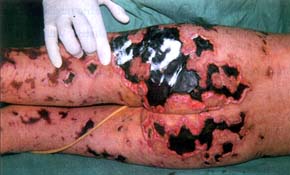 Fig. 5Focal necroses on the gluteal region.<br>&nbsp
