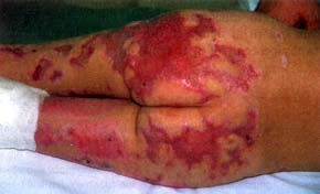 Fig. 6Healing defects on gluteal region - alter autotransplantation.