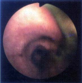 Inhalation Injury