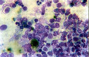 Fig. 4The cytological picture shows a markedly increased quantities of polynuclears. The polynuclears are degenerated, with gramentose nuclei, macrophages are also present, together with desintegrated and structurally altered cylindrical epithelia. (MGG, 40x)