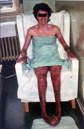 Fig. 1This 20-year-old girl refused any physiotherapy and any orthopaedic intervention and preferred to exhibit her deformed legs and feet.