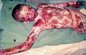 Fig. 3aFor example, this 9-year-old girl sustained a flame burn involving 67 % of TSBA.