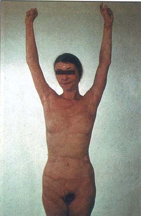 Fig. 3bShe has been followed-up for 24 years having achieved normal activity as a wife and mother.