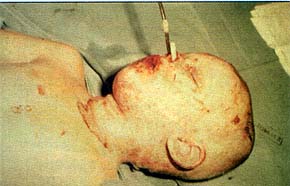 Fig. 4aThis 4-year-old girl sustained a very deep facial burn and inhalation injury. Her family requested withdrawal of treatment to prevent lier life-long suffering because of a disfigured face. An appropriate explanation resulted finally in good cooperation of th� whole family.