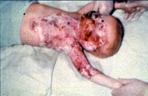 Fig. 5aThis 10-month-old girl sustained a severe burn under obscure conditions: lier mother intended to get rid of lier even after having been admitted to th� burn centre as accompanying person. Two years later th� child was adopted by another family that was coop�rative.