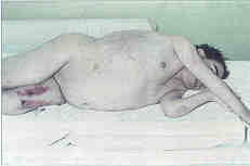 Fig. 128-year-old man: severe muscular dystrophy.