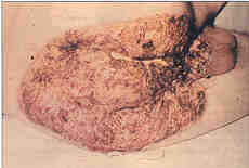 Fig. 228-year-old man: both buttocks, anus and posterior area of scrotum after necrectomy.