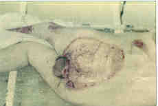 Fig. 328-year-old man: the perineum, buttocks and scrotum after autografting.