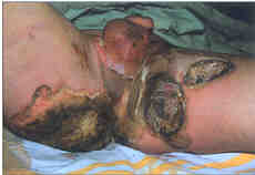 Fig. 4A)11-year-old boy: A - right upper extremity, B buttocks, perzneal and perianal region.