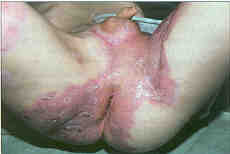 Fig. 511-year-old boy: the perineum and buttocks after closure with autografts.