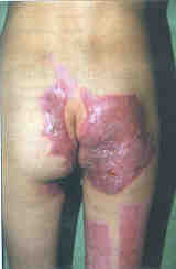 Fig. 611-yearold boy: shrinking of the perianal region.