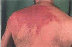 Fig. 1The scald on the back was deep, on the shoulder more superficial. The sharp borderline between the different types of affection is of interest - where the magic borderline at the level of the corium was passed. On the shoulder there will not be any permanent sequelae, on the back impaired pigmentation.